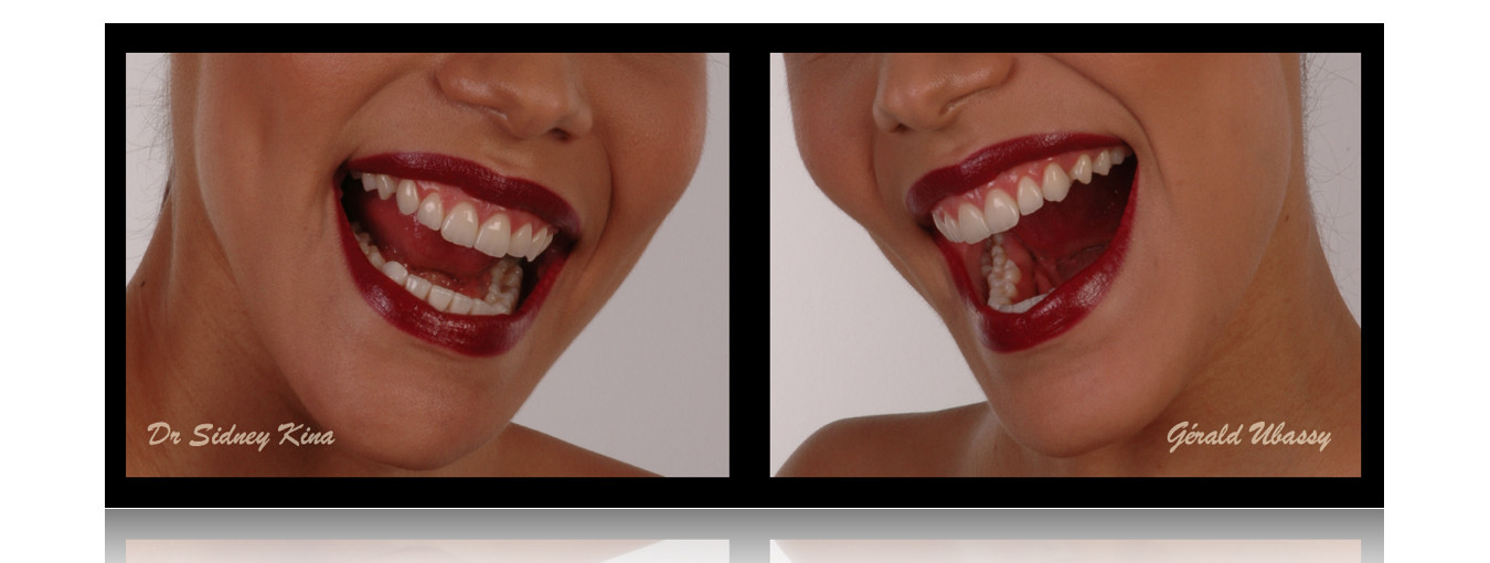 12 Veneers, Kina /Ubassy